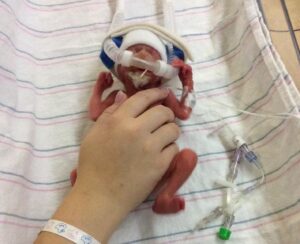 Baby Colton was small but he was a fighter.